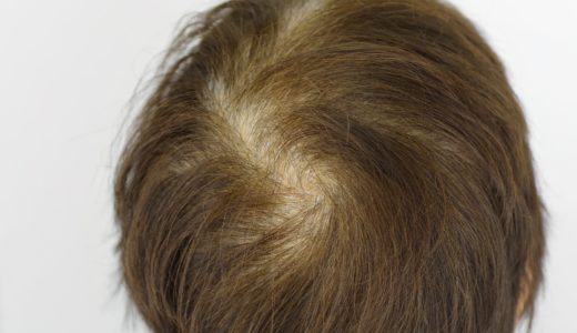 つむじが２つあるとはげる？女性のつむじはげの原因と対策